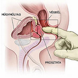 átadja a prosztata szexet A meddőségre gyakorolt​​ prostatitis befolyásolja